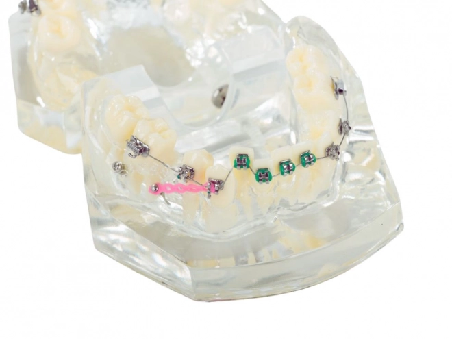 Modèle dentaire avec appareils orthodontiques