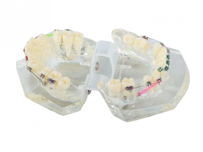 Modèle dentaire avec appareils orthodontiques