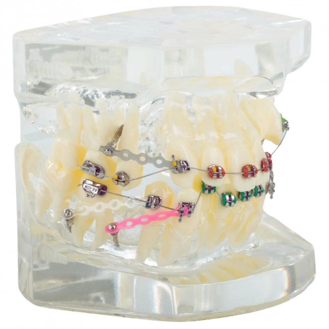 Modèle dentaire avec appareils orthodontiques
