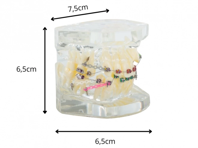 Modèle dentaire avec appareils orthodontiques