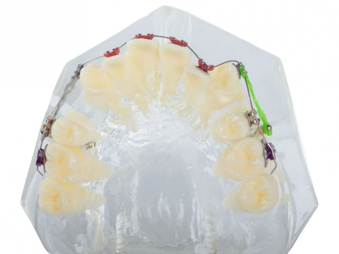 Modèle dentaire avec appareils orthodontiques