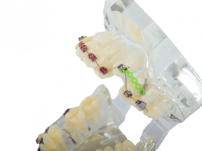Modèle dentaire avec appareils orthodontiques